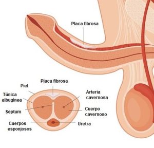 Curvatura peneana por Peyronie